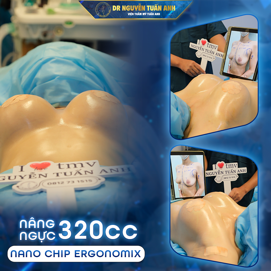 Nâng ngực Nano Chip Ergonomix