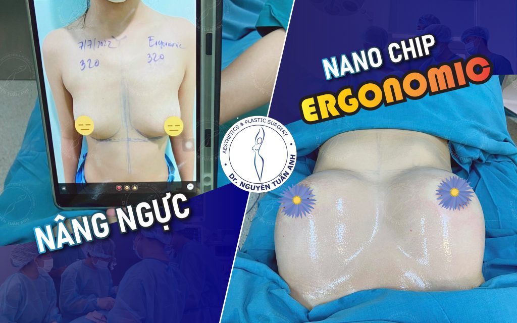 Nâng ngực thẩm mỹ tại Bệnh viện thẩm mỹ Nguyễn Tuấn Anh